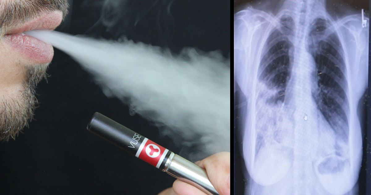lungs of a vape smoker Can Your Lungs Heal From Vaping? main image 0