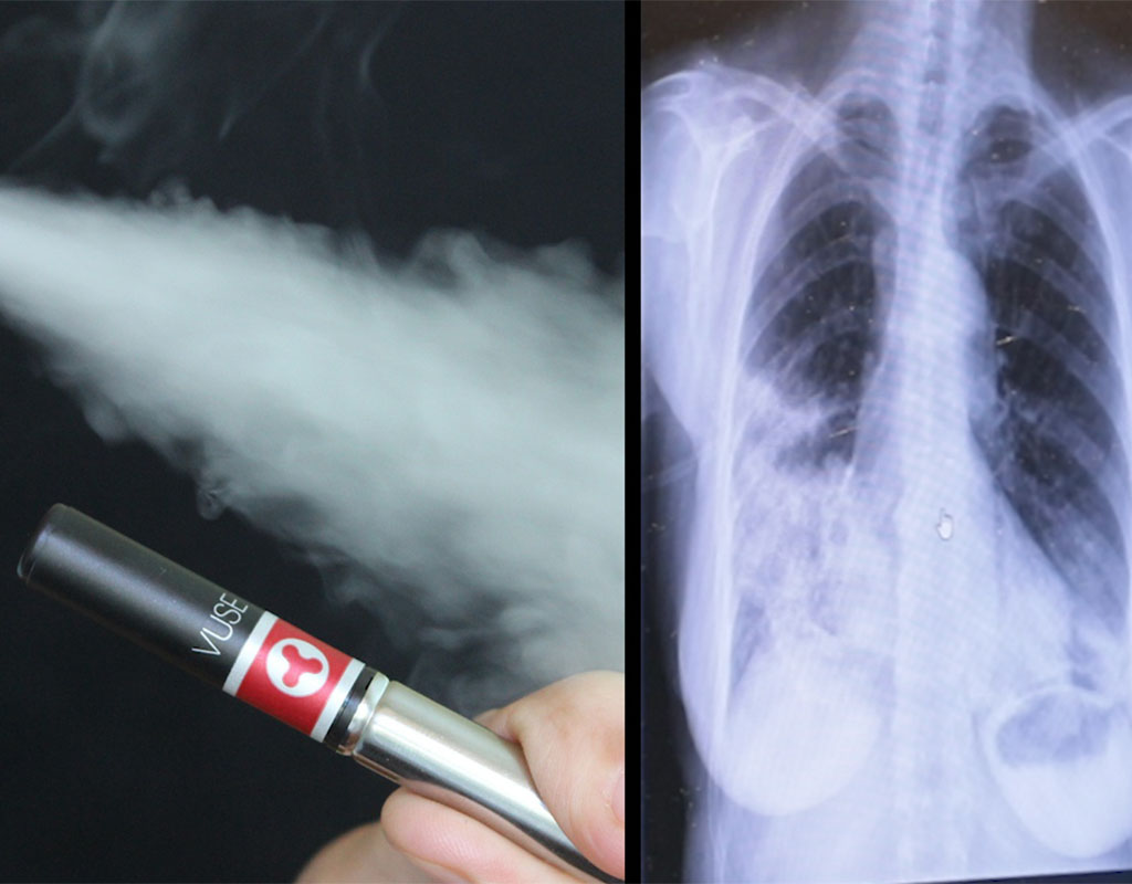 do thc vapes cause popcorn lung Truth Behind Vaping and Popcorn Lung main image 1
